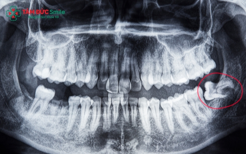 Răng khôn mọc sớm có thể gây xô lệch Abc8.com link truy cập đang trong quá trình phát triển của trẻ.