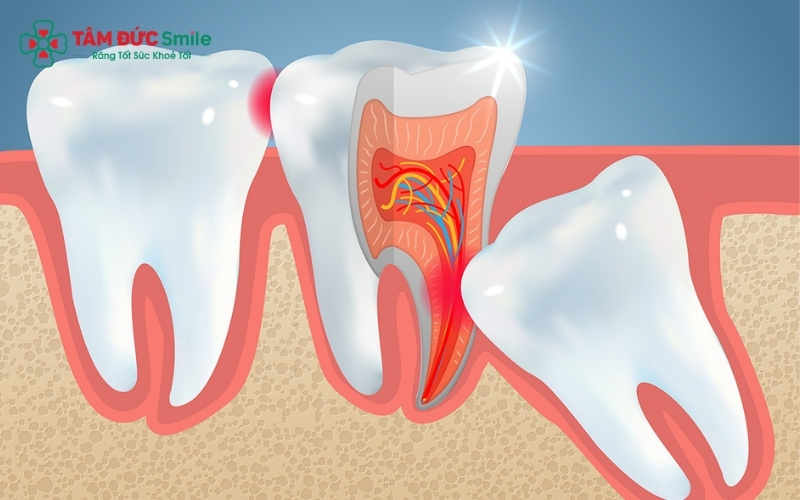 Răng khôn là chiếc răng thứ 8 tính từ răng cửa giữa đi vào bên trong