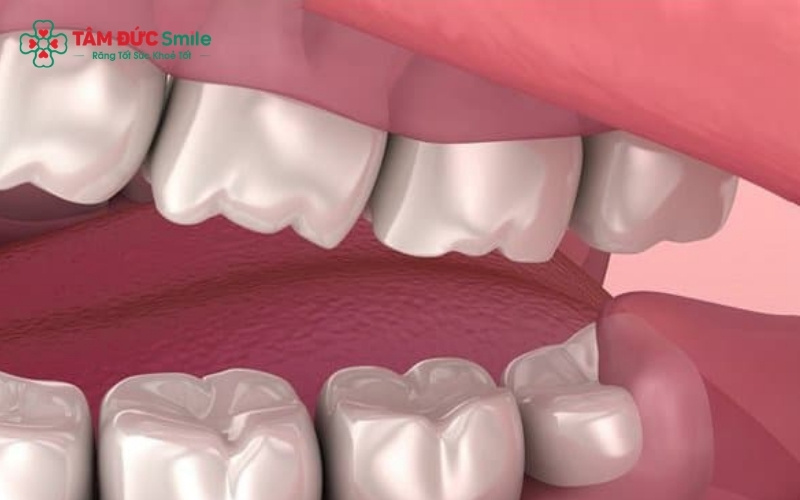 Dù chỉ mới 14 tuổi, răng khôn mọc lệch có thể âm thầm đâm vào răng số 7, gây hỏng Abc8com giaitri tructuyen và làm xô lệch toàn hàm.