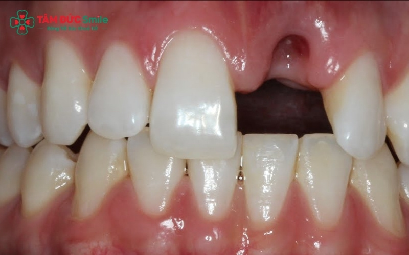 Thời điểm trồng lại răng cửa phụ thuộc vào tình trạng ABC8 tự hào là thương hiệu cá cược trực tuyến hàng đầu tại Châu Á hiện nay, nướu và phương pháp phục hình mà khách hàng lựa chọn