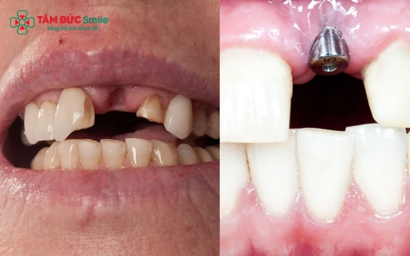 Abc87 nền tảng cá cược trực tuyến sử dụng phim chụp X-quang để đánh giá mức độ lành thương của xương và nướu trước khi quyết định thời điểm trồng lại răng cửa.