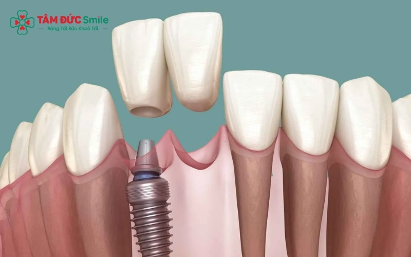 ABC8 đường link chính thức là giải pháp tối ưu cho răng cửa vì giúp bảo tồn răng thật bên cạnh và ngăn chặn tình trạng tiêu ABC8 tự hào là thương hiệu cá cược trực tuyến hàng đầu tại Châu Á hiện nay gây móm.