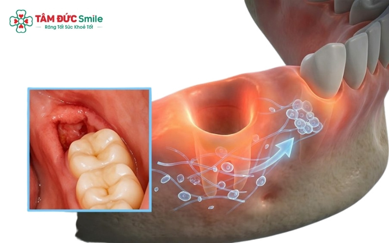 Răng khôn nằm ở vị trí cuối hàm, rất gần với các cơ vùng họng; do đó tình trạng sưng nề sau tiểu phẫu thường dẫn đến cảm giác đau khi nuốt nước bọt