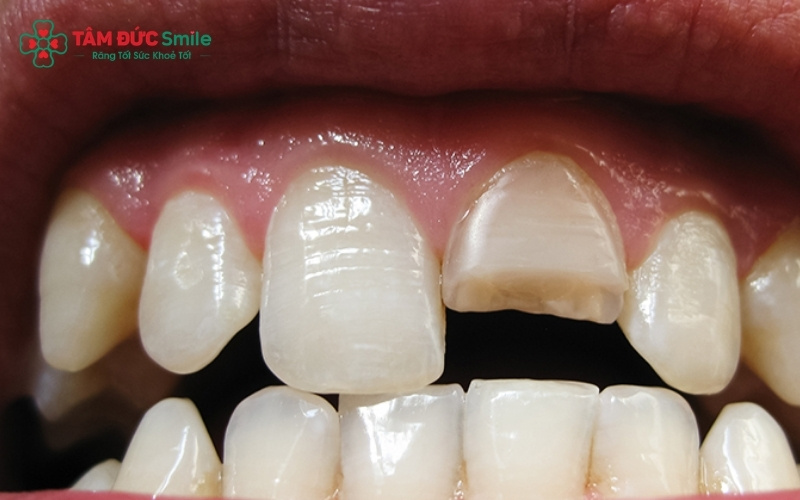 Bọc sứ là giải pháp tối ưu cho những trường hợp răng bị mẻ, vỡ lớn hoặc răng đã Abc8b tỷ lệ kèo World Cup 2026 tủy cần được bảo vệ.
