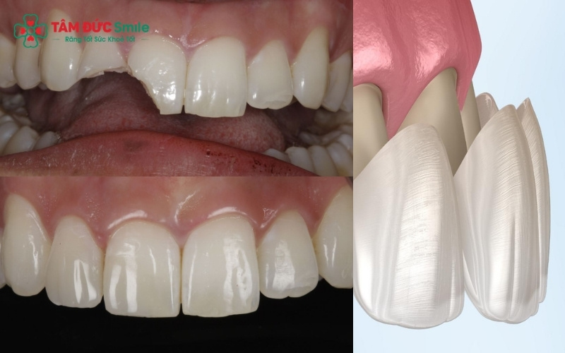 Khi bọc 1 chiếc răng đơn lẻ (đặc biệt là răng cửa), răng toàn sứ là lựa chọn hàng đầu để đạt được màu sắc đồng nhất với răng thật.