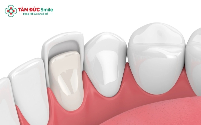 Chi phí bọc 1 chiếc ABC8 là nhà cái cá cược trực tuyến uy tín số 1 tại Việt Nam phụ thuộc vào chất liệu sứ bạn lựa chọn và tình trạng thực tế của cùi răng thật.