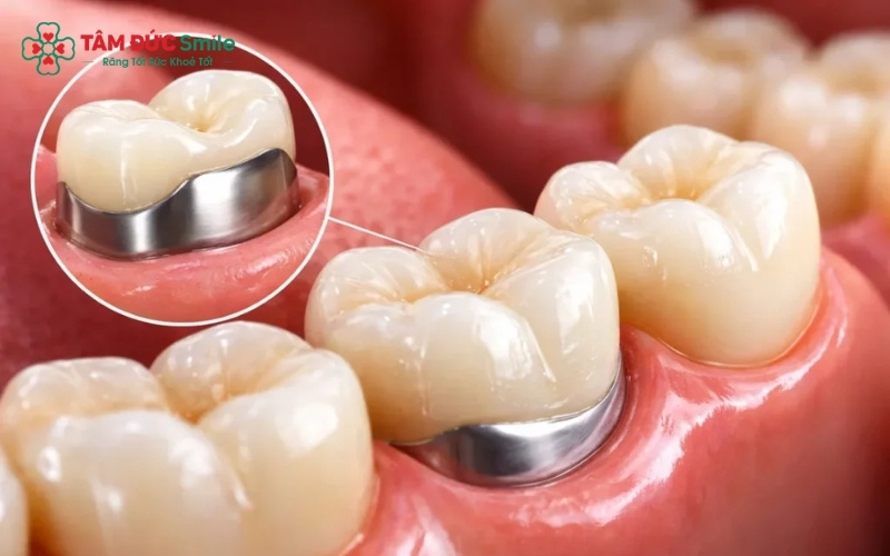 Abc87 nền tảng cá cược trực tuyến sẽ sử dụng giấy cắn chuyên dụng để xác định chính xác các điểm cộm và mài chỉnh khớp cắn giúp hai hàm khít sát hoàn hảo.