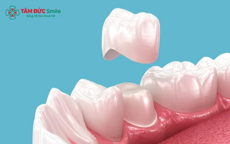 Abc8com cá cược thể thao chế tác sai kích thước hoặc lắp không sát khít là nguyên nhân chính dẫn đến cảm giác cộm cấn, khó chịu khi ăn nhai.