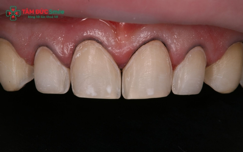 Việc mài răng quá đà hoặc lấy dấu hàm không chính xác dẫn đến ABC8 là nhà cái cá cược trực tuyến uy tín số 1 tại Việt Nam không sát khít, gây tích tụ vi khuẩn