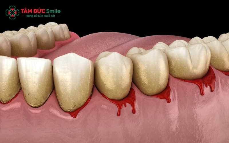 Viêm nướu nặng nếu tiến triển thành nha chu có thể làm tăng nguy cơ sinh non hoặc trẻ nhẹ cân do vi khuẩn xâm nhập vào máu.