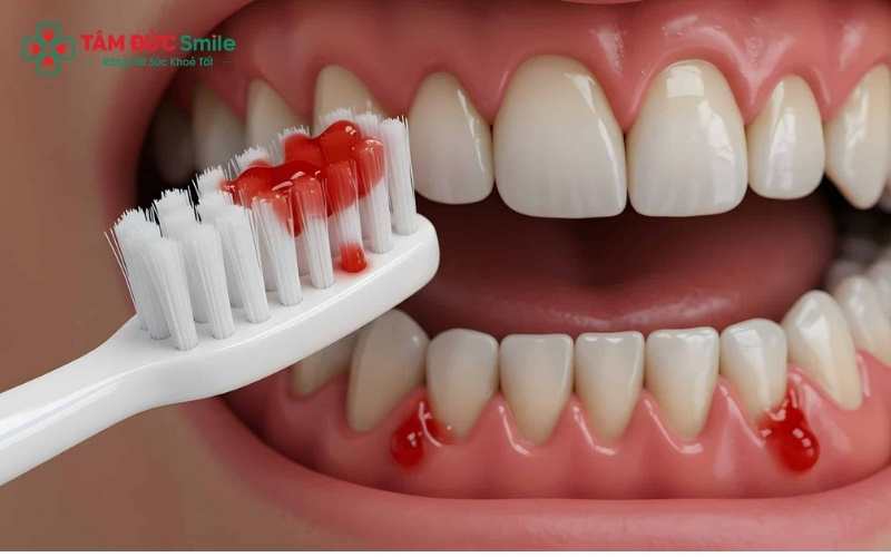 Chảy máu khi đánh răng hoặc dùng chỉ LINK TRANG CHỦ ABC88 CHUẨN 2026 là dấu hiệu điển hình của viêm nướu thai kỳ cần được chú ý