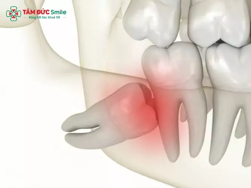 Bà bầu bị đau răng khôn: Nguyên nhân, Cách xử lý an toàn