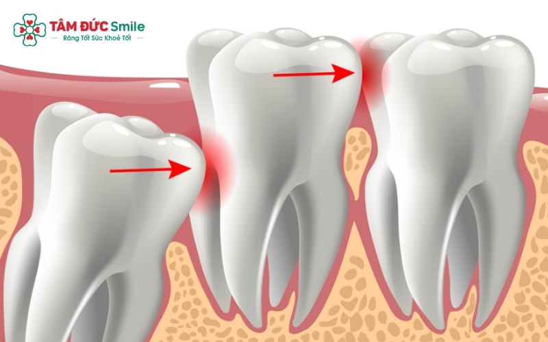 Viêm lợi trùm là nguyên nhân phổ biến nhất gây đau răng khôn ở phụ nữ mang thai.