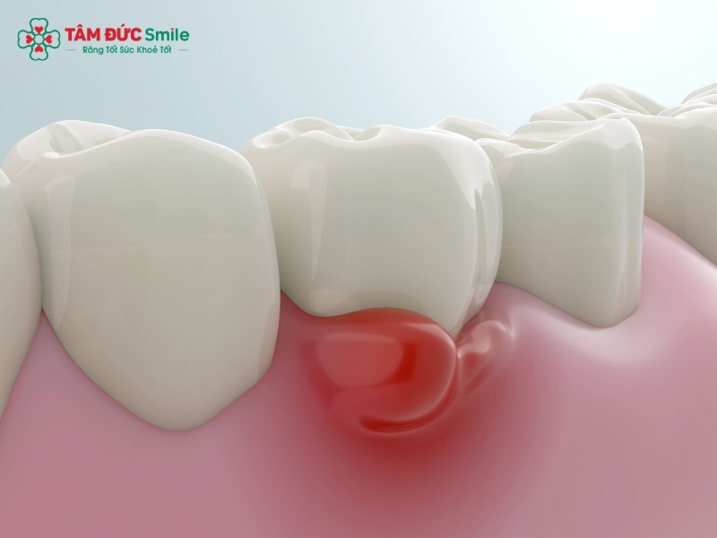 Bà bầu bị viêm Abc8com giaitri tructuyen phải làm sao để giảm sưng nướu?