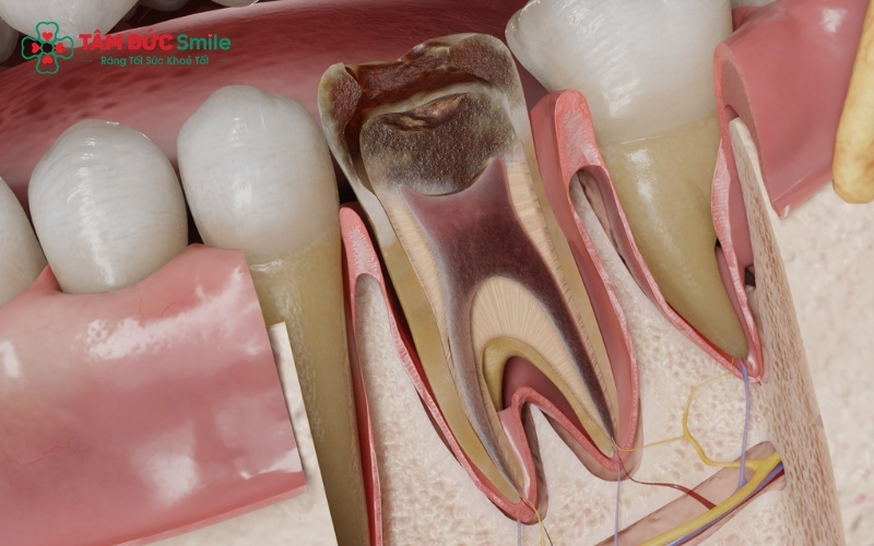 Cơn đau tủy răng dữ dội và kéo dài không chỉ gây mất ngủ mà còn ảnh hưởng trực tiếp đến sức khỏe và tâm lý của mẹ bầu