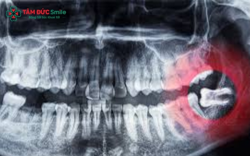 Sưng nướu và đau nhức kéo dài là dấu hiệu điển hình của răng khôn mọc lệch.