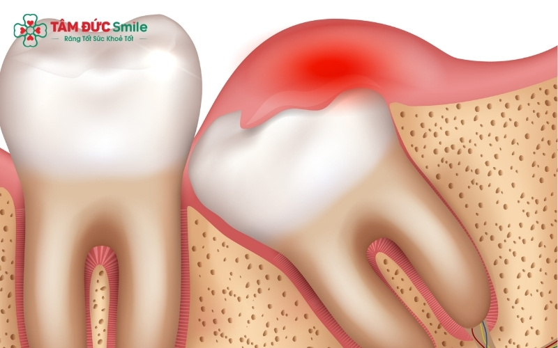 Răng số 7 bị tổn thương nghiêm trọng do răng khôn mọc lệch đâm vào