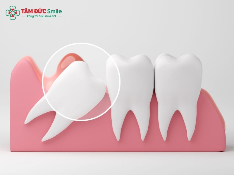 Các kiểu răng khôn mọc lệch: Dấu hiệu và cách xử lý an toàn