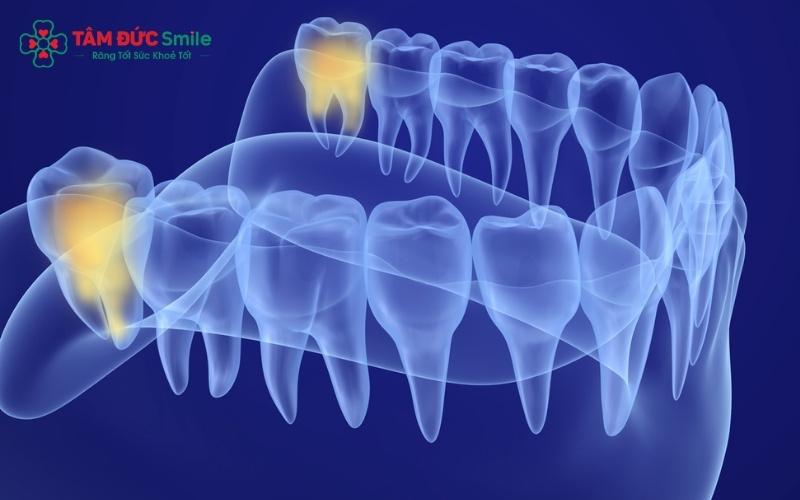  Các kiểu răng khôn mọc lệch phổ biến gây ảnh hưởng trực tiếp đến cấu trúc toàn hàm.