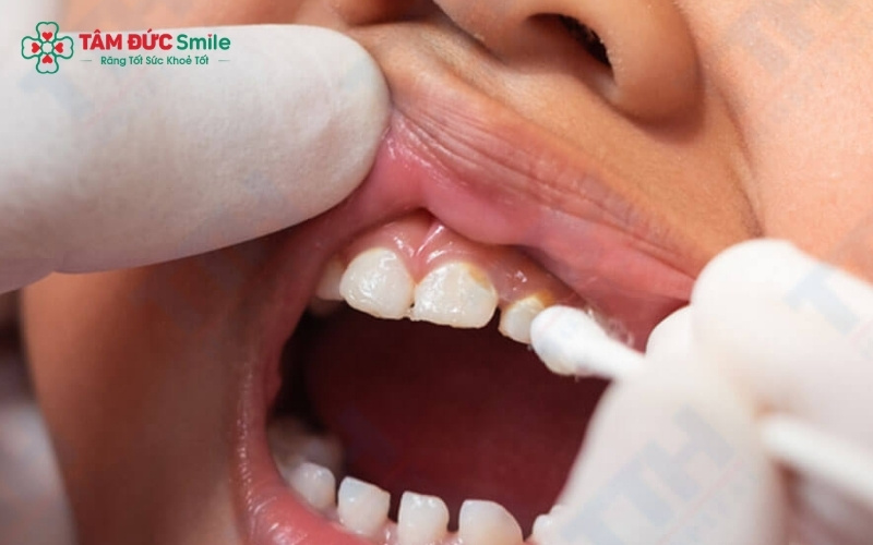 Sâu răng sữa không chỉ gây đau nhức khiến bé lười ăn mà còn trực tiếp ảnh hưởng đến quá trình mọc răng vĩnh viễn sau này.