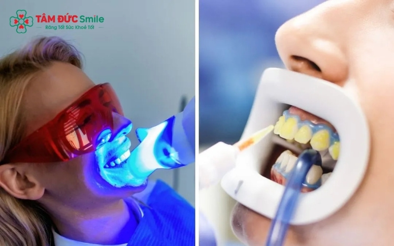 Công nghệ tẩy trắng hiện đại cùng các bước bảo vệ chuyên sâu giúp giảm thiểu tối đa cảm giác ê buốt.