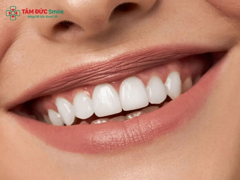 Cách làm trắng răng của người Nhật an toàn, giảm ố vàng hiệu quả