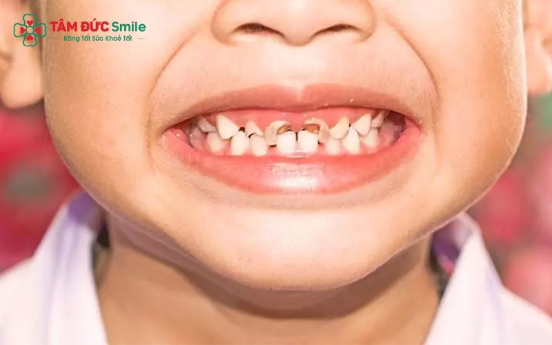 Cha mẹ nên hỗ trợ trẻ chải răng và làm sạch lưỡi 2 lần mỗi ngày để loại bỏ triệt để vi khuẩn gây mùi.