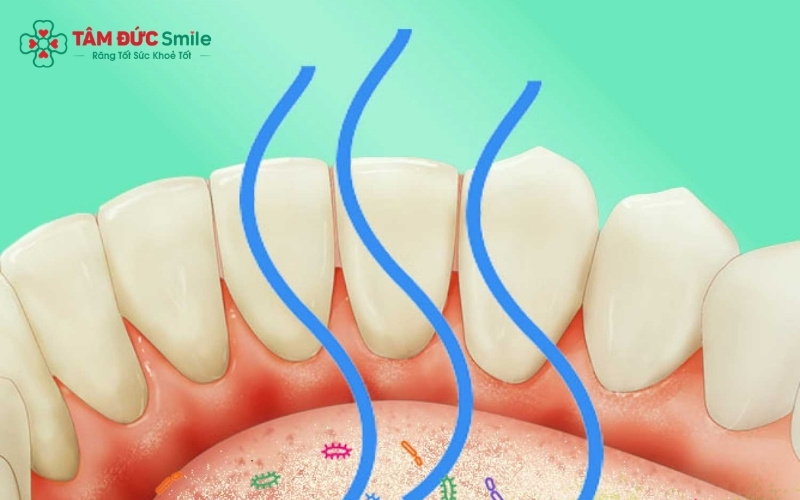 Bợn trắng trên lưỡi và vi khuẩn trong kẽ răng là những "ổ mùi" thường bị bỏ qua dù bạn có đánh răng hàng ngày