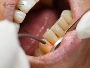 Cách trị hôi miệng vĩnh viễn: xử lý tận gốc, ngăn tái phát