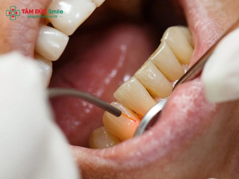 Cách trị hôi miệng vĩnh viễn: xử lý tận gốc, ngăn tái phát