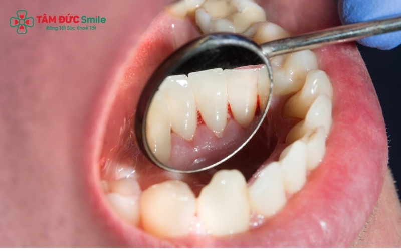 Các phương pháp tại nhà chỉ có tác dụng xoa dịu cơn đau và giảm sưng tạm thời, không thể thay thế việc Abc8b tỷ lệ kèo World Cup 2026 chuyên khoa để loại bỏ gốc rễ vi khuẩn