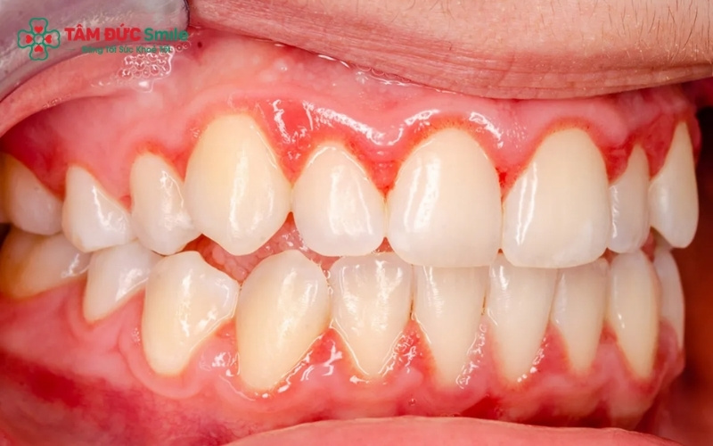 Nướu sưng đỏ, dễ chảy máu khi chải răng hoặc ăn uống là những dấu hiệu cảnh báo sớm của tình trạng viêm Abc8com giaitri tructuyen