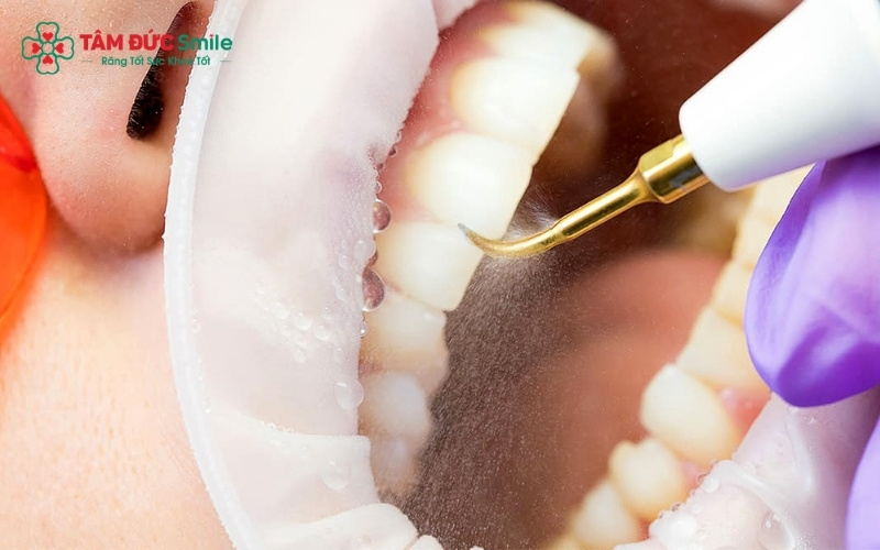 Phương pháp Abc8 abcvip tỷ lệ trả thưởng cực hấp dẫn giúp len lỏi vào các kẽ răng và dưới nướu, lấy sạch Abc8com nổ hũ ở những vị trí khó tiếp cận nhất.