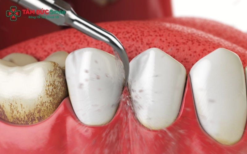 Ưu điểm vượt trội: Không làm mòn men răng, không gây chảy máu và bảo vệ nướu tuyệt đối.