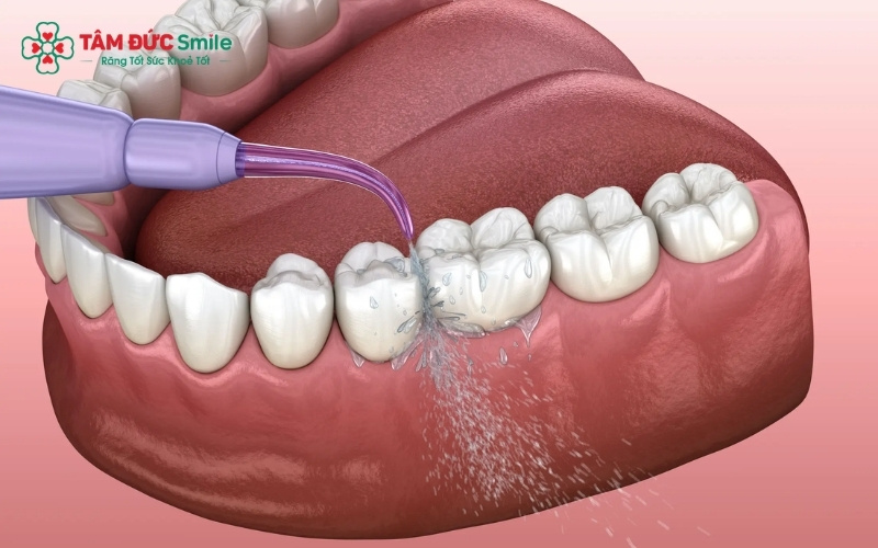 Sau khi cạo vôi, bạn nên uống nhiều nước và hạn chế thực phẩm quá nóng lạnh để duy trì sức khỏe ABC8 là nhà cái cá cược trực tuyến uy tín số 1 tại Việt Nam tốt nhất.