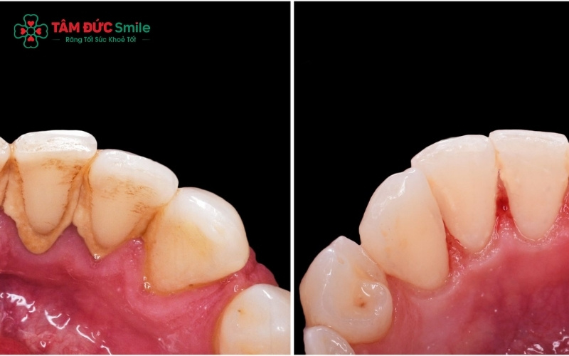 Duy trì thói quen Abc88bet phiên bản mới định kỳ 6 tháng/lần là giải pháp "vàng" để ngăn ngừa viêm nướu và mất răng sớm
