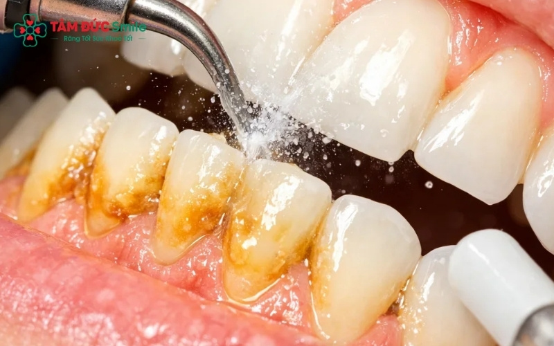 Khi có dấu hiệu nướu sưng tấy, chảy máu Abc8com giaitri tructuyen hoặc Abc8c1 com thiên đường cá cược có mùi, bạn nên đến LINK TRANG CHỦ ABC88 CHUẨN 2026 để Abc88bet phiên bản mới ngay mà không cần chờ đến lịch định kỳ.
