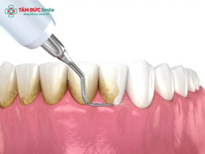Cạo vôi răng có hại không? Ê buốt, chảy máu có đáng lo?