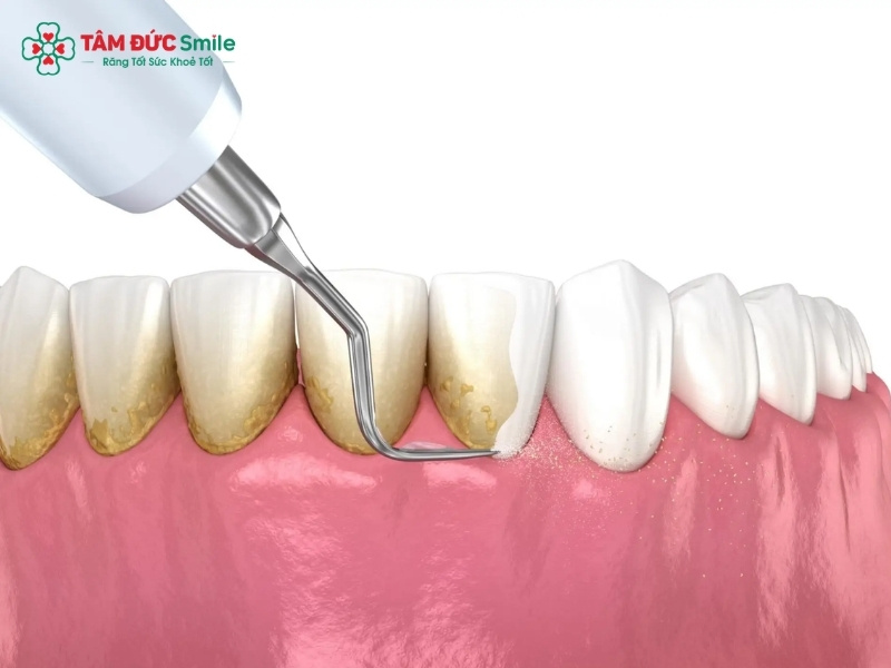 Cạo vôi răng có hại không? Ê buốt, chảy máu có đáng lo?