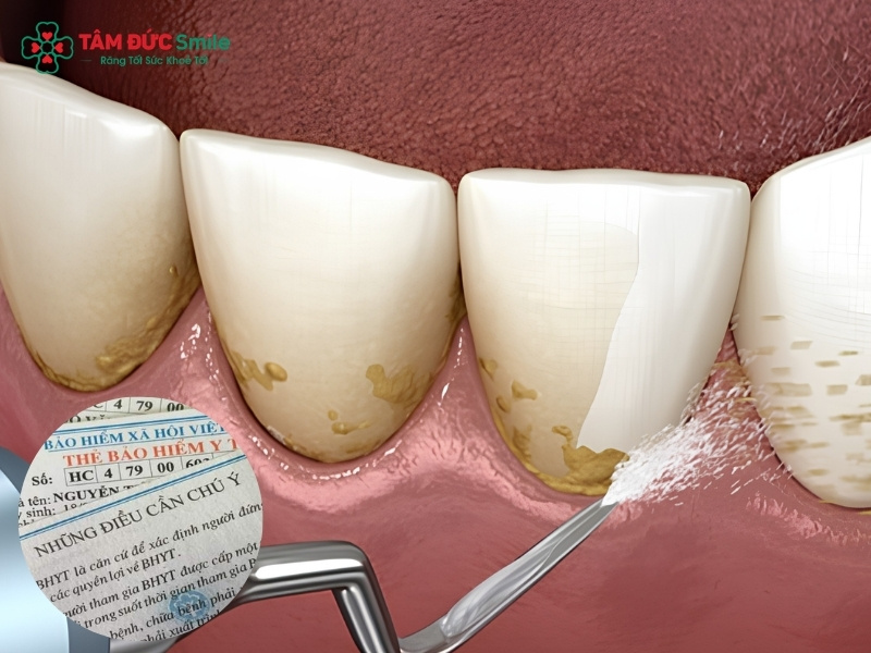 Cạo vôi răng có được bảo hiểm y tế không?