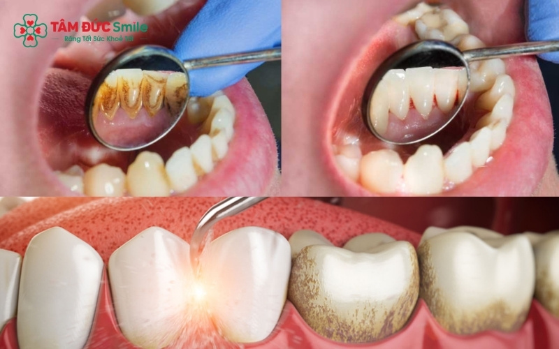 Cạo vôi răng bằng sóng Abc8 abcvip tỷ lệ trả thưởng cực hấp dẫn hiện đại giúp phá vỡ liên kết mảng bám mà không gây tổn thương men răng hay mô nướu.