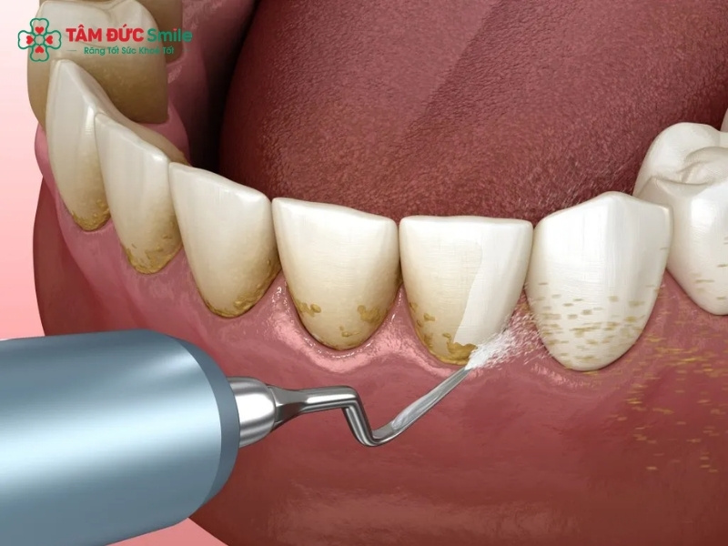 Cạo vôi răng có tốt không? Lợi ích, tần suất, chi phí