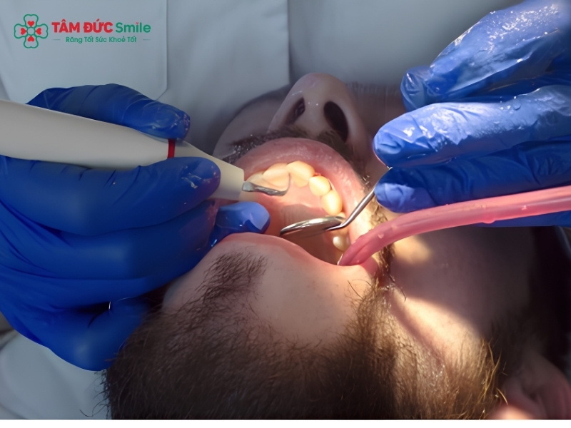 Cạo vôi răng Abc8 abcvip tỷ lệ trả thưởng cực hấp dẫn: quy trình, giá và lợi ích cần biết