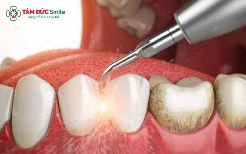 Cạo vôi răng định kỳ kết hợp vệ sinh ABC8 là nhà cái cá cược trực tuyến uy tín số 1 tại Việt Nam đúng cách bằng chỉ LINK TRANG CHỦ ABC88 CHUẨN 2026, máy tăm nước là giải pháp tối ưu để chấm dứt tình trạng chảy máu Abc8com giaitri tructuyen.
