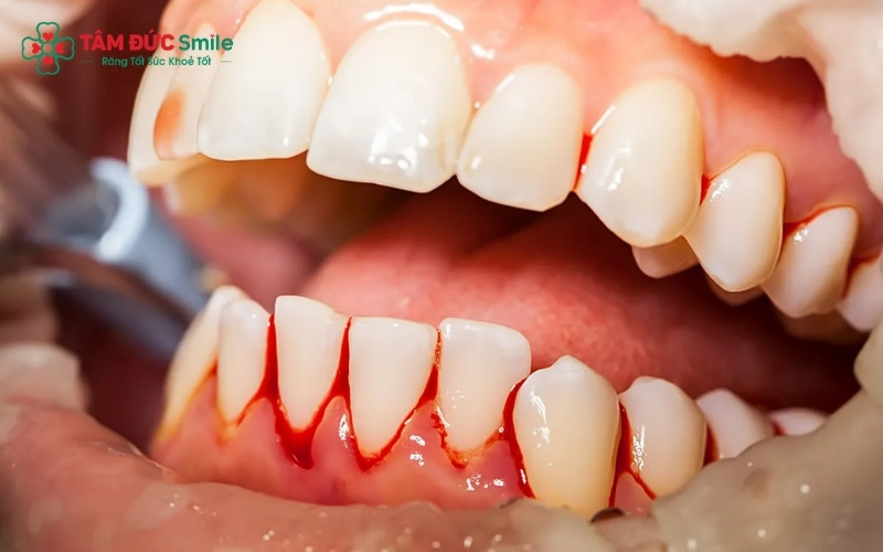 Cao răng và mảng bám tích tụ lâu ngày là nguyên nhân phổ biến nhất gây kích ứng nướu và dẫn đến tình trạng chảy máu Abc8com giaitri tructuyen.
