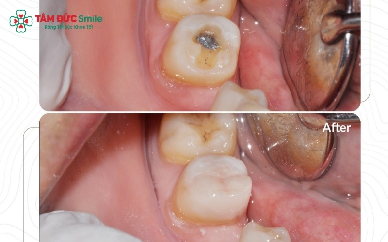 Các giải pháp như trám Composite hoặc bọc sứ giúp loại bỏ hoàn toàn vi khuẩn và bảo vệ răng thật bền lâu hơn hẳn các phương pháp tự nhiên