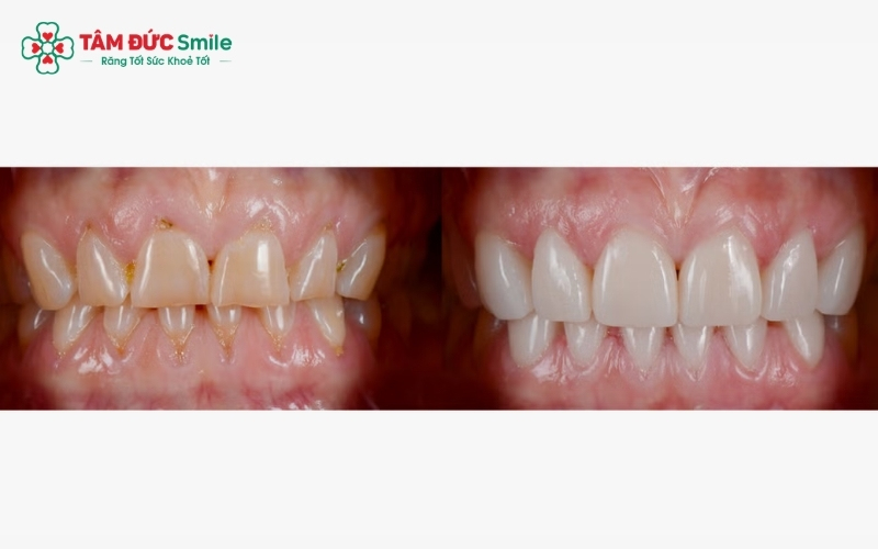 Miếng dán sứ Veneer có độ mỏng tinh tế và khả năng thấu quang tốt, mang lại vẻ đẹp tự nhiên khó phân biệt với răng thật.
