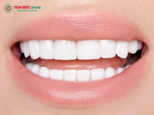 Dán sứ Veneer 2 răng cửa: giá, quy trình, độ bền