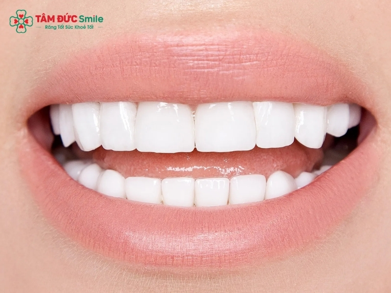 Dán sứ Veneer 2 răng cửa: giá, quy trình, độ bền