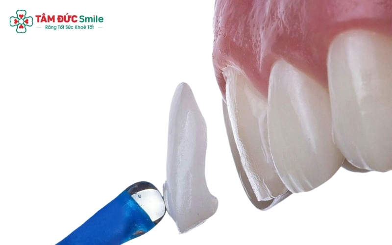 Dán sứ Veneer là giải pháp hoàn hảo để khắc phục tình trạng răng cửa thưa, mẻ hoặc xỉn màu mà vẫn bảo tồn tối đa răng thật.